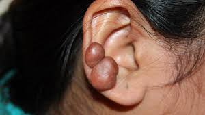 <p>firm/nodular/hypertrophic mass of scar tissue</p><p>form after minor trauma (ear piercing)</p><p>m/c→dark skin</p>