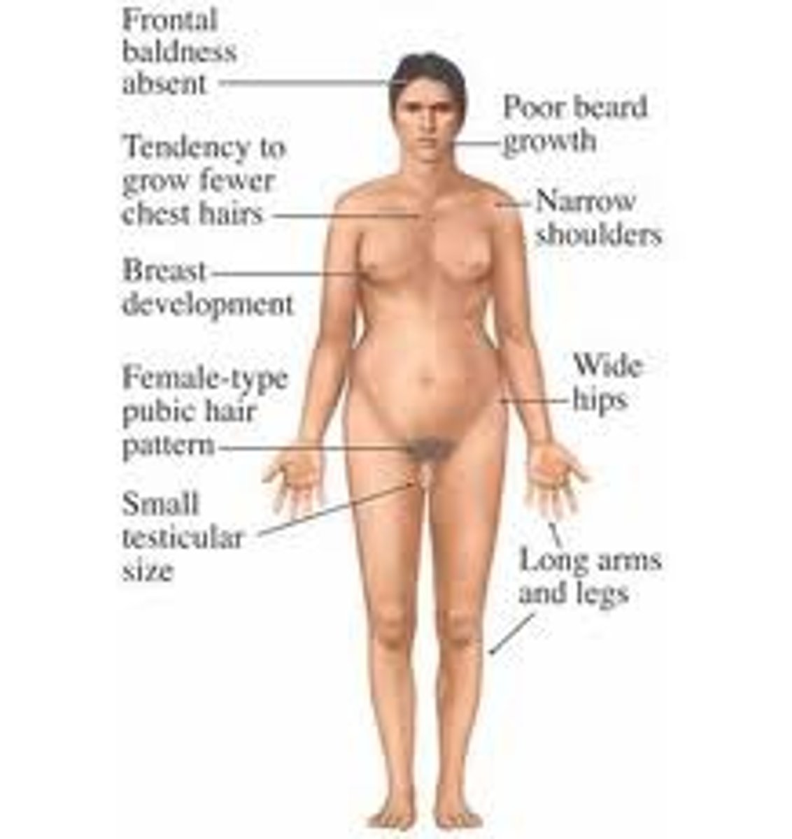 <p>- XXY</p><p>- Testes</p><p>- Internal: Wolffian duct (AMH + T)</p><p>- External: masculinization (DHT)</p>