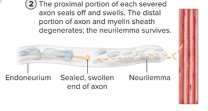<p>a. proximal portion of severed axon seals off and swells<br>b. distal portion of the axon degenerates and neurilemma survives</p>