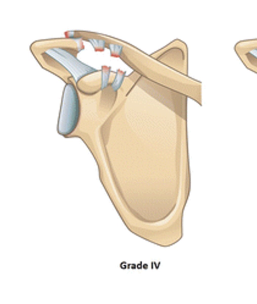 <p>According to the Rockwood Classification System, a grade IV ACJ separation entails: __________</p>