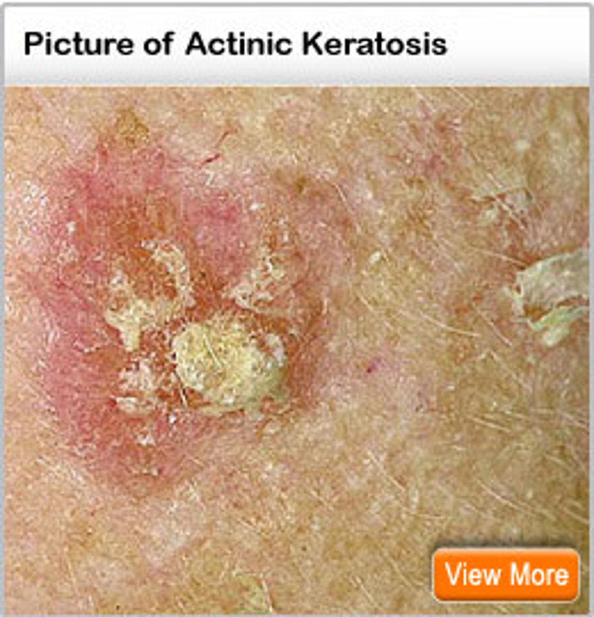 <p>d. "Your cheek area will be painful and develop eroded areas that will take weeks to heal."</p><p>Topical 5-FU causes an initial reaction of erythema, itching, and erosion that lasts 4 weeks after application of the medication is stopped. The medication is topical, so there are no systemic effects such as increased infection risk, anorexia, or nausea</p>