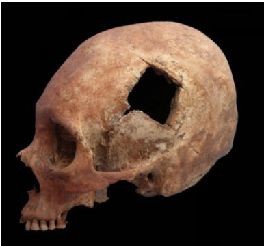 <p>Trepanation 6500 BCE</p>