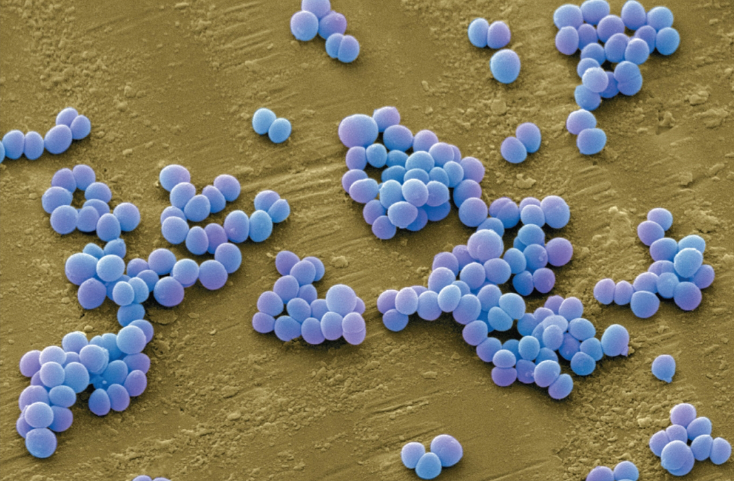 <p><span style="background-color: transparent;"><em><span>Staphylococcus aureus</span></em></span></p><p><span style="background-color: transparent;"><span>often become resistant against antimicrobial drugs; usually treated with </span><strong><span>vancomycin </span></strong></span></p><p><span style="background-color: transparent;"><span>— part of normal flora; a large amount is needed for infection</span></span><br><span style="background-color: transparent;"><span>— Proper aseptic technique and cleansing keeps it in check</span></span></p><p></p>