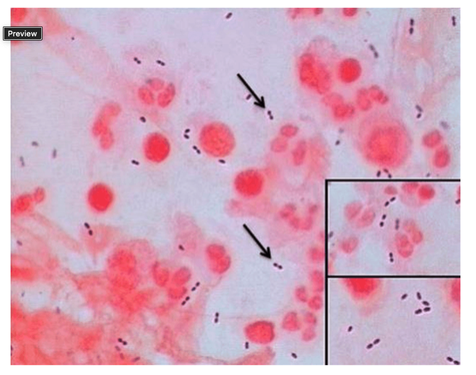 <p>The culture above grew an alpha hemolytic gram positive cocci.&nbsp;&nbsp;</p><p>Optochin disk zone:&nbsp; 16mm.</p><p>What is the organism identification?</p><p>&nbsp;</p><p>Erysipelothrix rhusiopathae</p><p>&nbsp;</p><p>Corynebacterium species</p><p>&nbsp;</p><p>Streptococcus viridans</p><p>&nbsp;</p><p>Streptococcus pneumoniae</p>