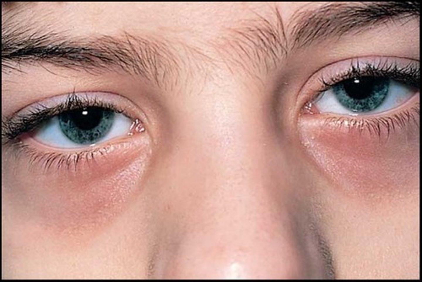 <p>dark circles under eyes</p><p>aka me constantly</p>