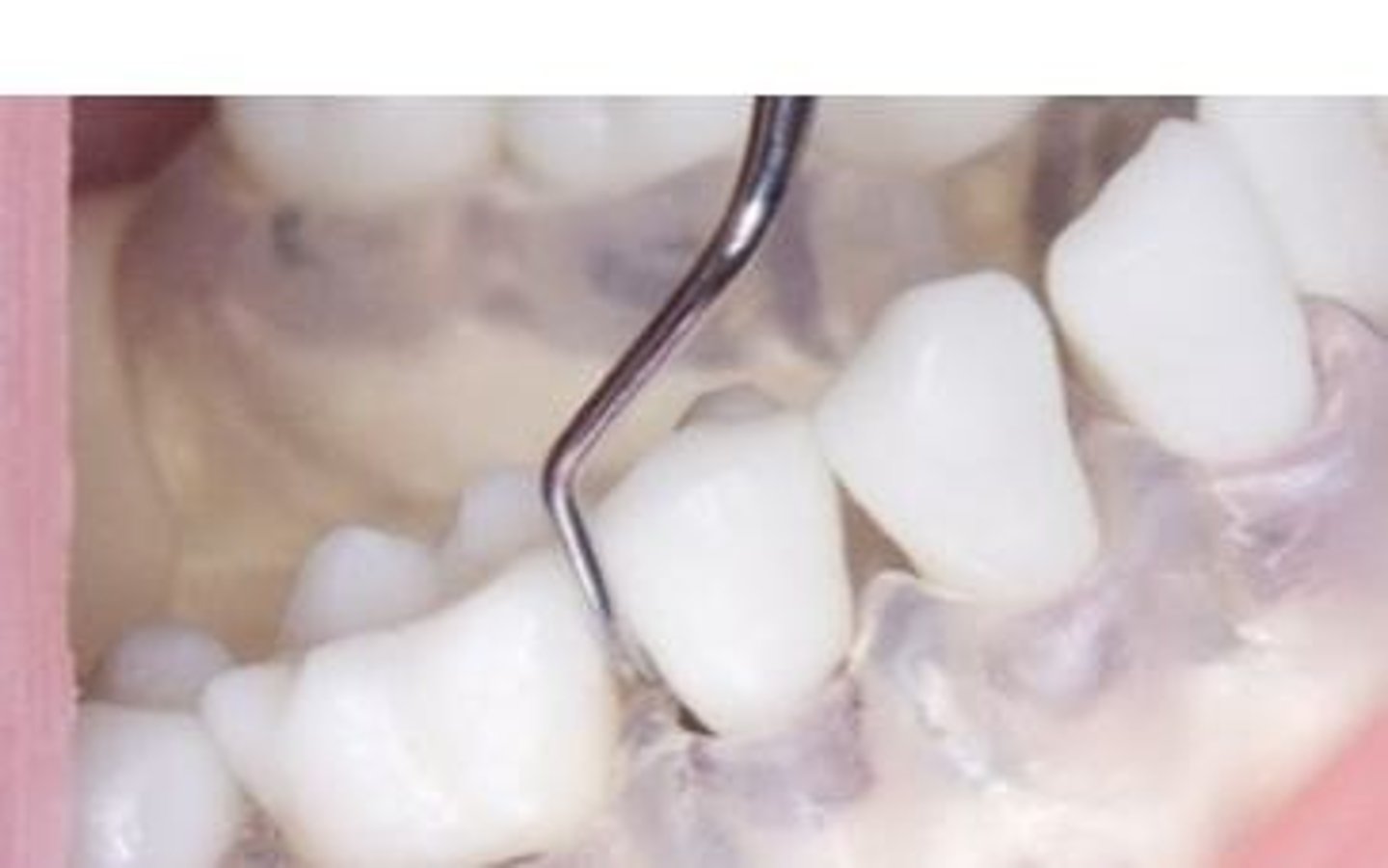 <p>With direct vision (stained biofilm picks up extrinsic stains, thick biofilm appears dull with matted fur appearance &amp; thin biofilm is translucent and may need a disclosing agent to see), use of explorer or probe, use of a disclosing agent or using biofilm index clinical record.</p>