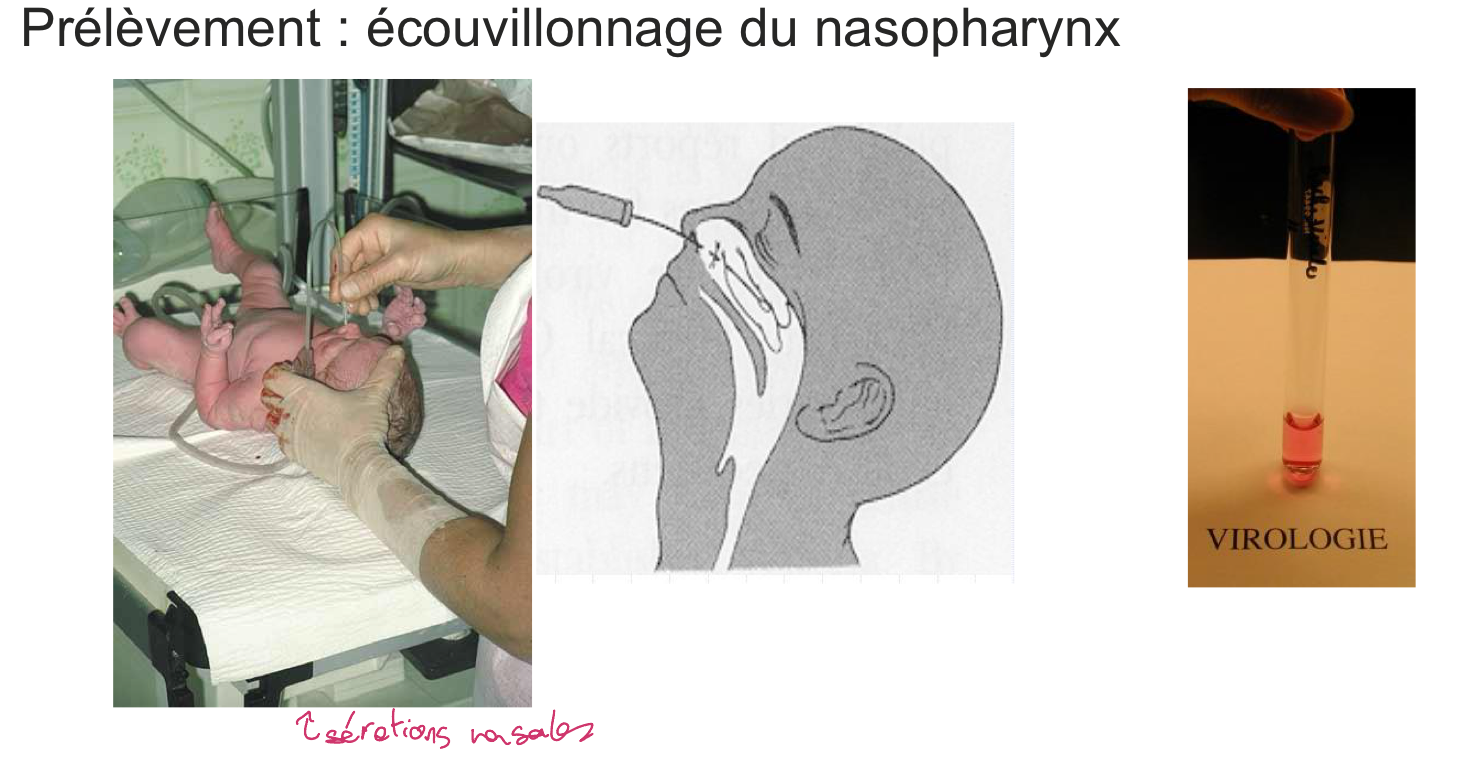<p>échantillon nasopharynx </p><p></p>