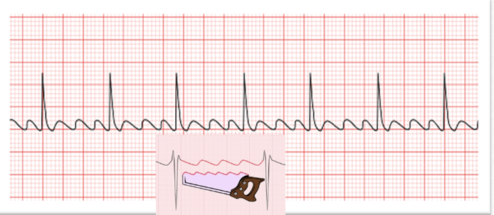 <ul><li><p class=""><strong>Rate</strong>: <em>Atrial</em> — <mark data-color="yellow" style="background-color: yellow; color: inherit">250 to 400 bpm</mark>; <em>Ventricular</em> — <mark data-color="yellow" style="background-color: yellow; color: inherit">75 to 150 bpm</mark></p></li><li><p class=""><strong>Rhythm</strong>: Atrial regular; Ventricular usually regular but may be irregular due to changes in AV conduction</p></li><li><p class=""><strong>P Waves</strong>: Saw-toothed, referred to as <em>F</em> waves</p></li><li><p class=""><strong>P to QRS Ratio</strong>: 2:1, 3:1, or 4:1</p></li><li><p class=""><strong>PR Interval</strong>: Multiple <em>F</em> waves make determination difficult</p></li><li><p class=""><strong>QRS Complex</strong>: Usually normal</p></li></ul><p></p>