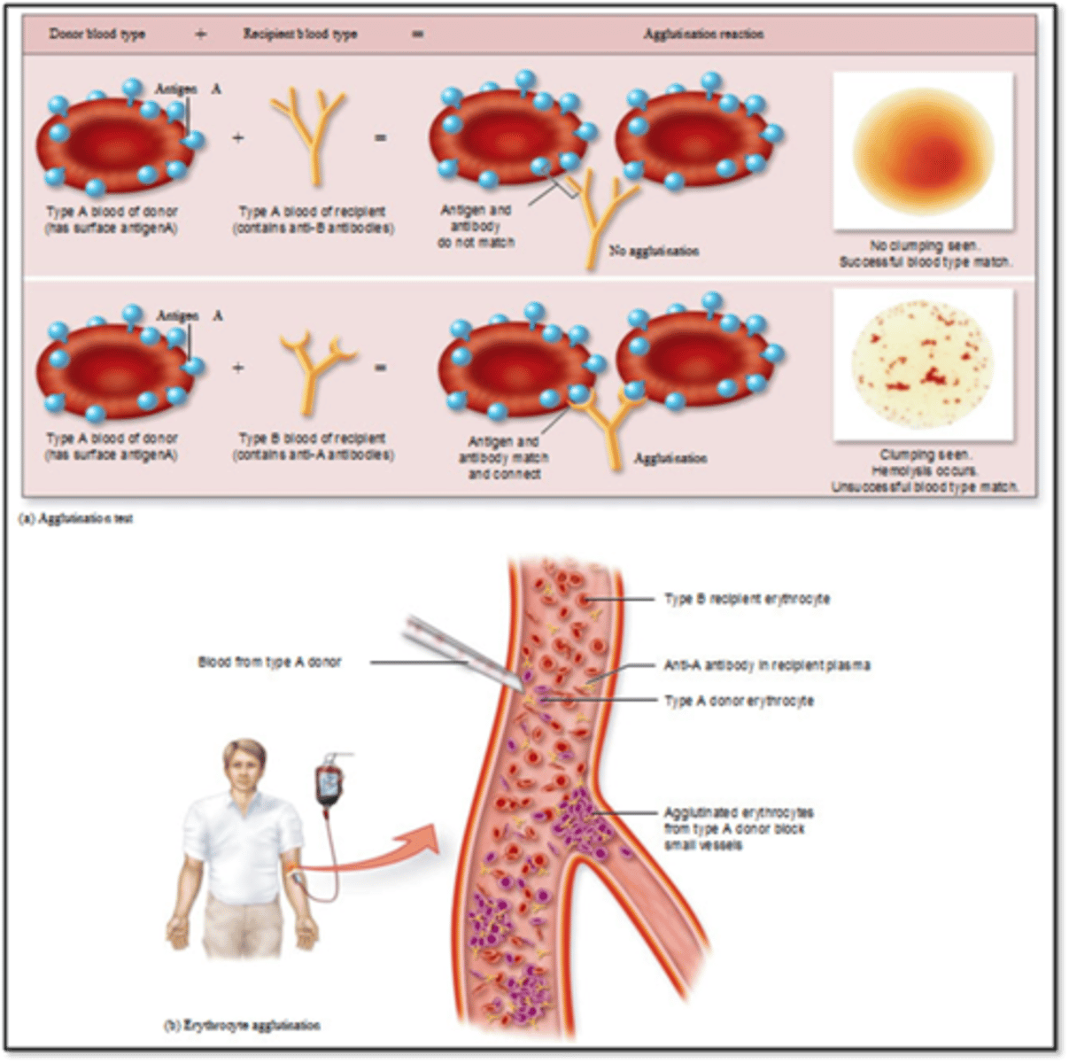 <p>- Too robust response</p><p>- IgG or IgM binds with an antigen on person's own cell</p><p>- Tissue specific (usually blood cells)</p><p>- Effects: Phagocytosis, cell lysis</p><p>- Incompatible blood transfusion</p><p>- Erythroblastosis fetalis: RH negative mom with RH positive child</p>