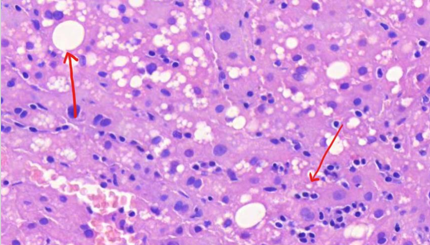 <p><strong><u>MIKÄ TAUTI?</u></strong> lobulusten puolella pieniä tulehdussoluinfiltraatteja hepatosyyttien välissä, osassa hepatosyyteistä rasvapisaroita, tämä löydös sopii lievään rasvadegeneraatioon, joka on tyypillistä krooniselle c-hepatiitille</p>