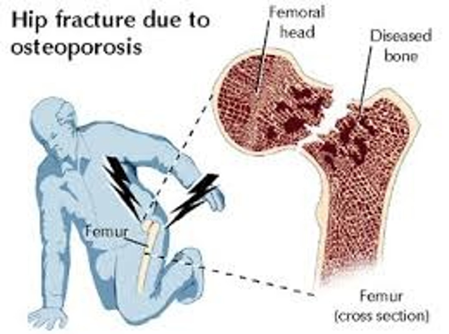 <p>A fracture of a hip weakened by osteoporosis that can occur spontaneously or as the result of a fall.</p>