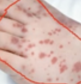 <p>Vascular Skin Lesion</p><ul><li><p><strong>Rupture of fine blood vessels</strong> from<strong> trauma</strong> or <strong>clotting</strong> problem</p></li><li><p><strong>Reddish </strong>to <strong>purplish</strong> color (in comparison with hematoma)</p></li></ul><p></p>
