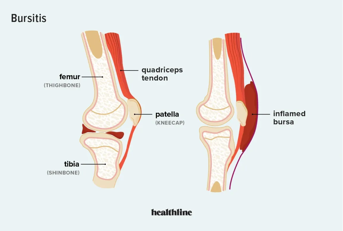 <p>Bursitis, when the bursa is irritated, Bursitis can cause pain, swelling, redness, stiffness, and a loss of motion</p><p><mark data-color="yellow">Bursa</mark>: Fluid filled sacs that reduce friction and facilitate movement. </p><p></p>