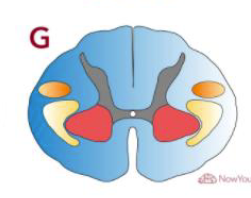 <p>Describe the effects of the lesion</p>