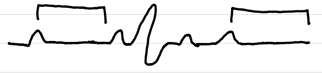 <ul><li><p>rate: slow (<span style="color: red;">ventricular < atrial</span>)</p></li><li><p>rhythm: regular</p></li><li><p>P waves: normal</p></li><li><p>PR interval: varies, <span style="color: red;">no relation to QRS</span></p></li><li><p>QRS complexes: <span style="color: red;">usually >0.10 sec</span></p></li><li><p>ST segments: normal</p></li></ul><p></p>
