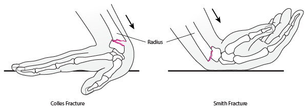 break in distal radius
