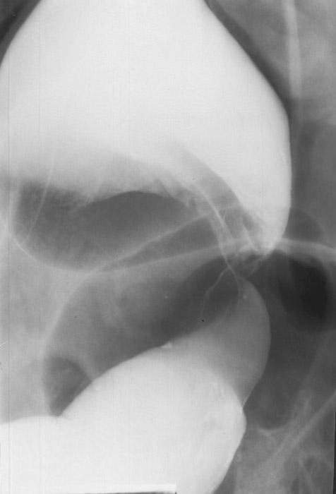 <p>Volvulus → revolve → twist.</p>