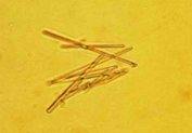 <p>Normal</p><ul><li><p>protein rich diet</p></li><li><p>usually not reported</p></li><li><p>seen in refrigerated specimens</p></li></ul><p></p>