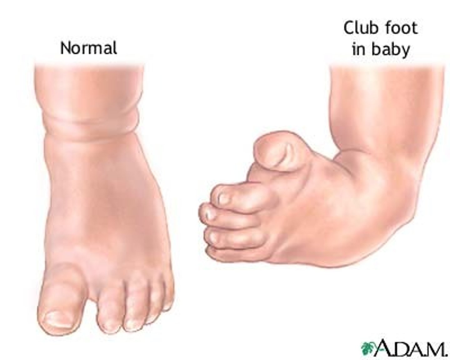 <p>ankle and foot are down and in (club foot)</p>
