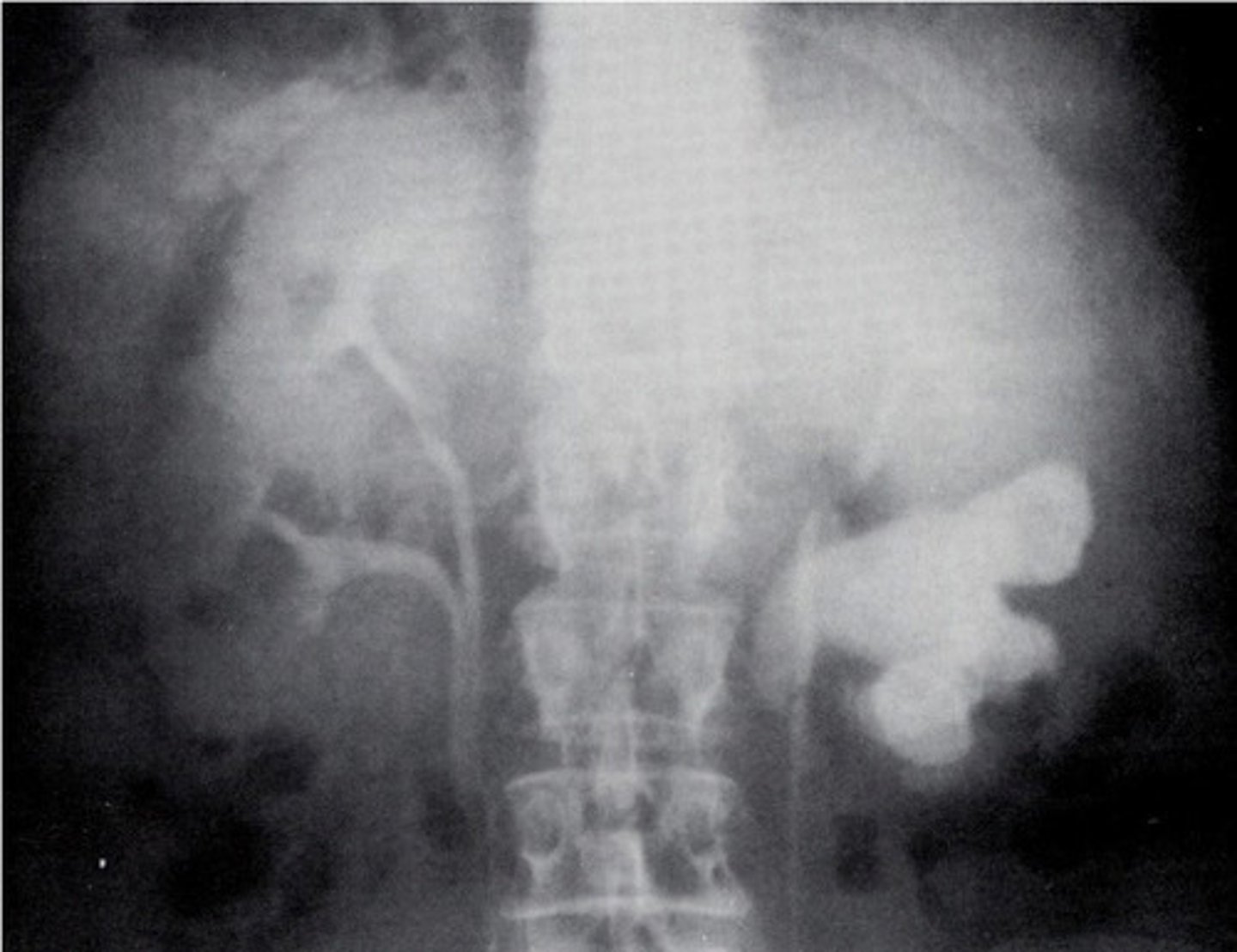<p>What is a large stone that completely fills the renal pelvis?</p>