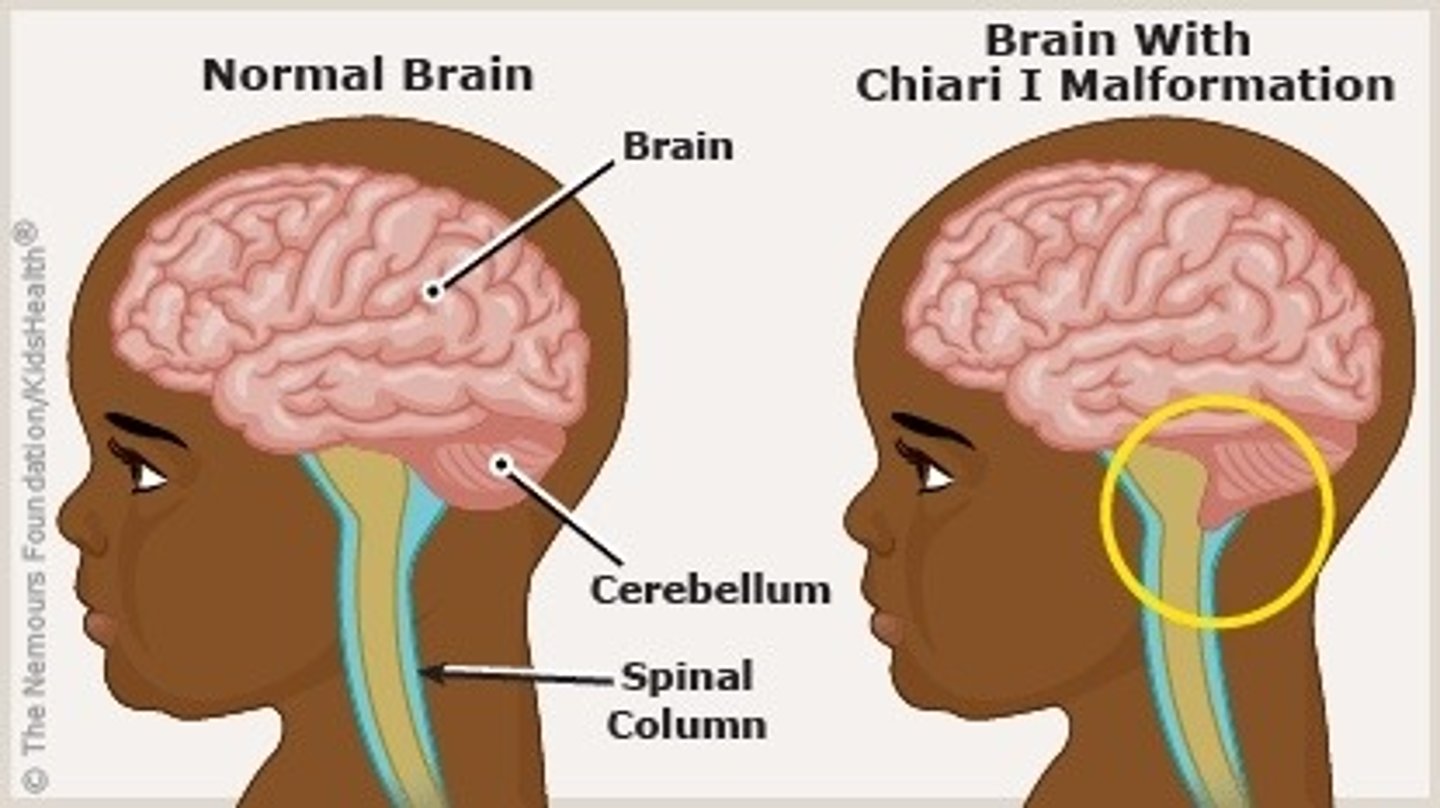 <p>Define Arnold-Chiari malformations</p>