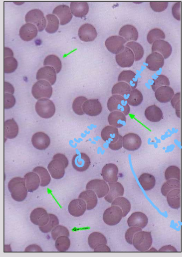<p><strong><mark data-color="yellow" style="background-color: yellow; color: inherit;">Multiple myeloma</mark></strong> or other disorders associated with increased globulins/paraproteins </p>