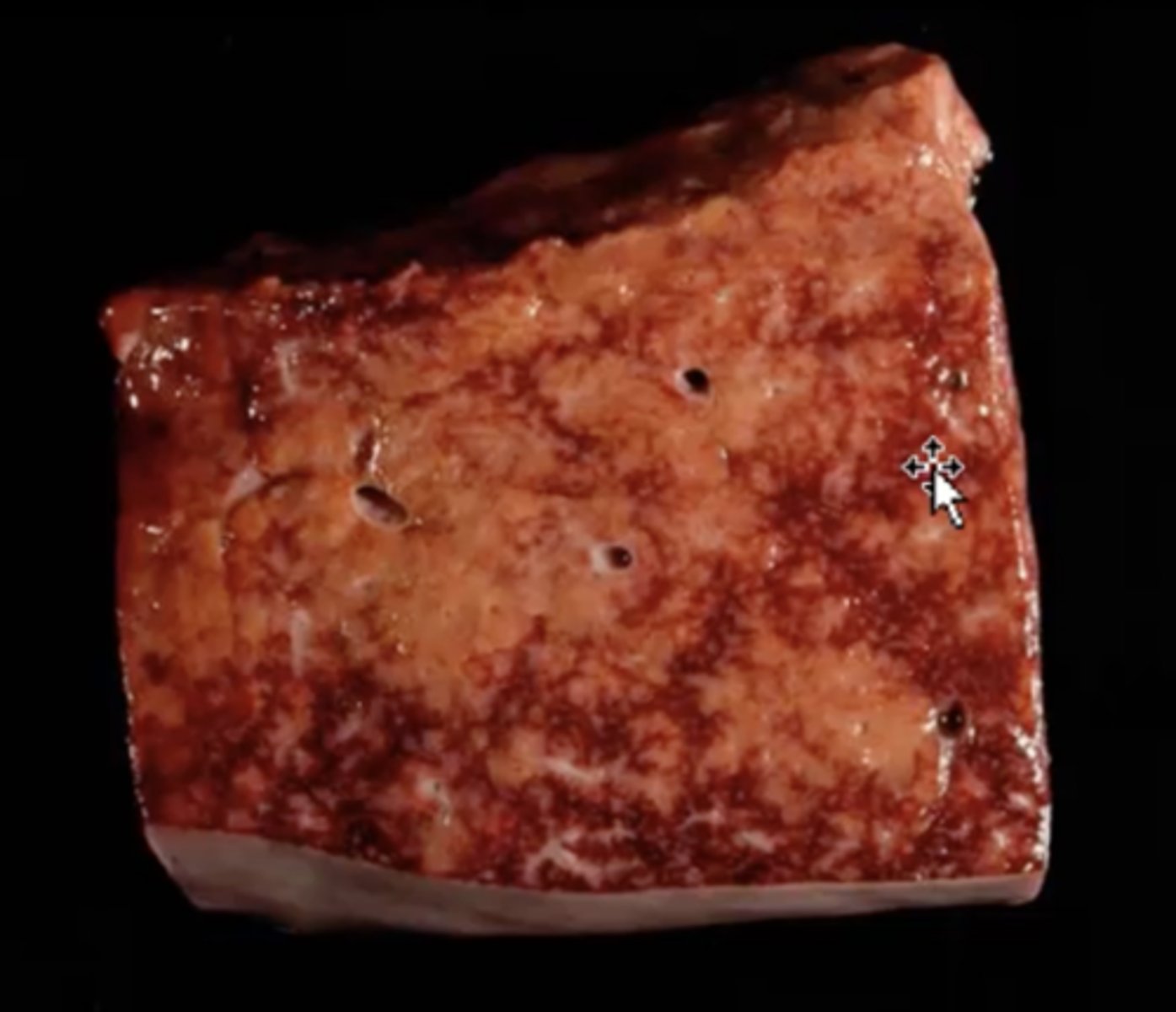 <p>What has caused this gross appearance of this liver?</p>