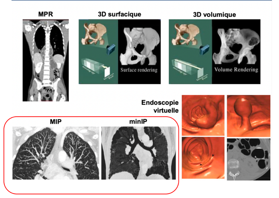 <p>En fonction de comment on règle le protocole d’imagerie, on peut voir :</p><ul><li><p>Les zones qui atténuent au maximum les rayons comme les os →<em>Multiplanar reconstruction (MPR)</em></p></li><li><p><strong>Imagerie de surface</strong> (3D surfacique)</p></li><li><p><strong>Imagerie volumique </strong>(3D volumique)</p></li><li><p><strong>Endoscopie virtuelle</strong> : on peut reconstruire l’intérieur de l’intestin par exemple pour voir s’il y a des polypes→ça évite de faire des coloscopies ou des fibroscopies</p></li><li><p>Sur la même image, en fonction de si on fait ressortir le contraste de ce qui absorbe le plus ou inversement, au niveau des poumons, on va soit pouvoir voir l'arbre vasculaire pulmonaire (MIP) soit les alvéoles bronchiques (minIP) alors qu'il s'agit du même patient, on a juste réglé le contraste différemment.</p></li></ul><p><em>MIP : Maximum Intensity Projection vs minIP : Minimum Intensity Projection</em></p>