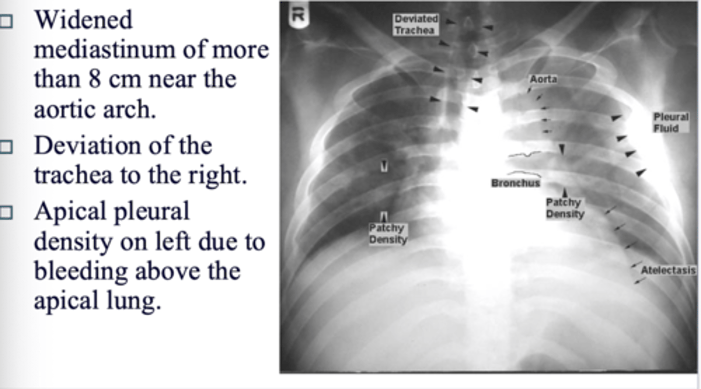 <p>◼ Widened mediastinum of more than 8 cm near the aortic arch.</p><p>◼ Deviation of the trachea to the right.</p><p>◼ Apical pleural density on left due to bleeding above the apical lung.</p>