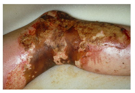 <p>Full thickness</p><ul><li><p><em>Epidermal and dermal layers completely destroyed</em></p></li><li><p><em>Hair follicles are completely destroyed</em></p></li><li><p><em>All nerve endings are destroyed</em></p></li><li><p><em>Damage to the peripheral vascular system</em></p></li></ul><p></p>