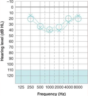 <p>What is a “cookie-bite” pattern of hearing loss?</p>