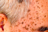 <p>EXPECTED AGE-RELATED CHANGES</p><p>slightly raised, wartlike macules with distinct edges appear</p><p></p>