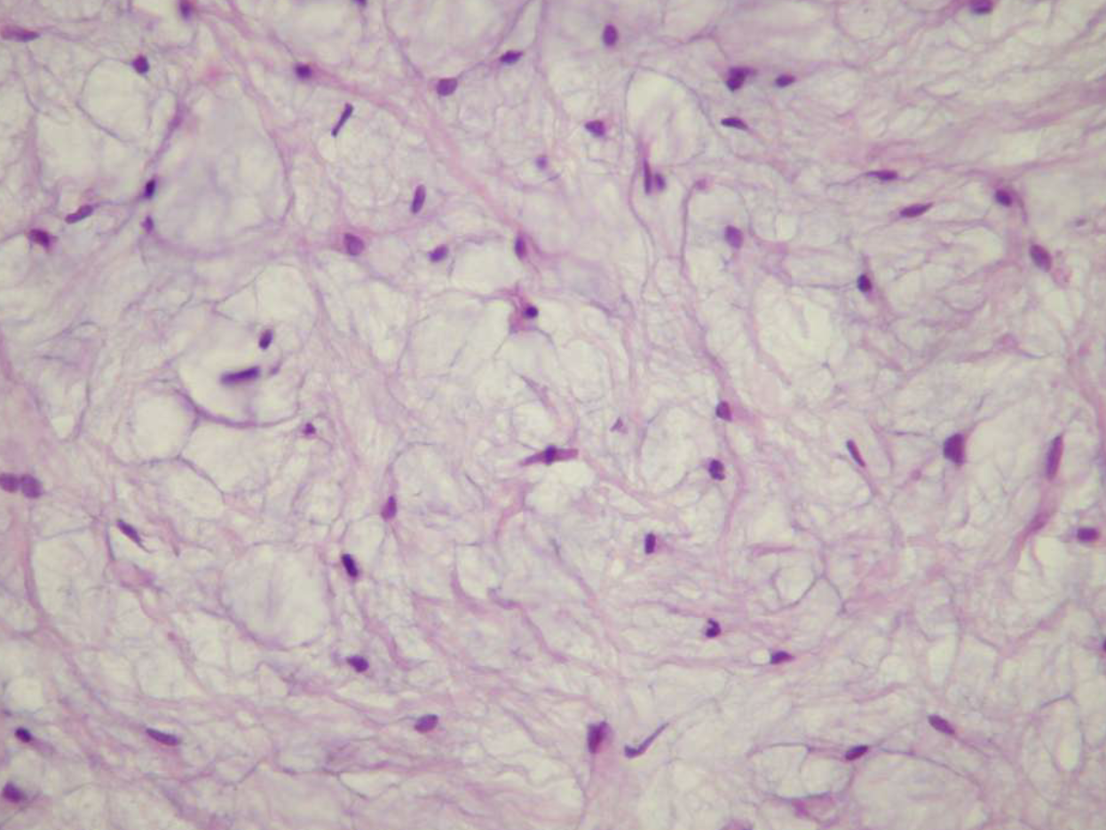 <ol><li><p>loose stroma w/ collagen fibrils </p></li><li><p>haphazardly arranged stellate, spindle-shaped, round cells</p></li></ol><p></p>