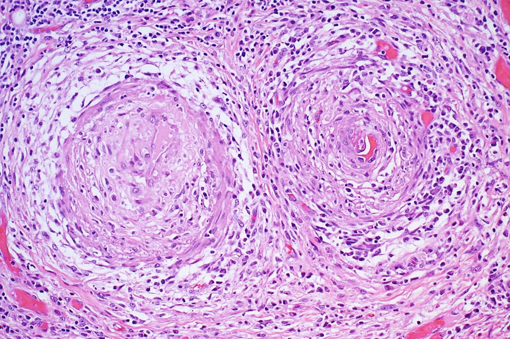 <p>TYPE 3 HYERSENSITIVITY</p><p>causes systemic vasculitis, sometimes by hepB antigens</p>