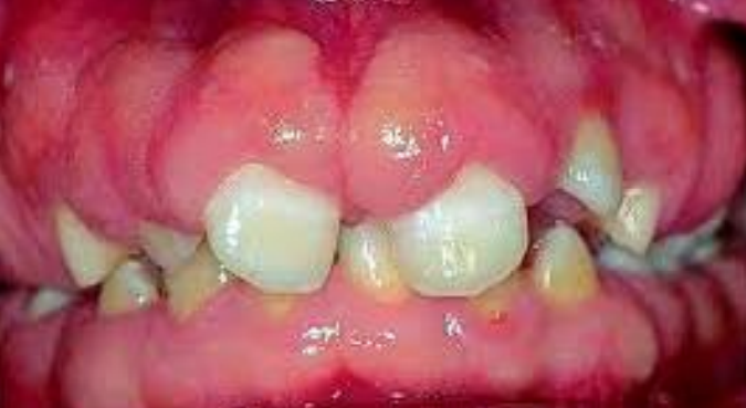 Gingival hyperplasia