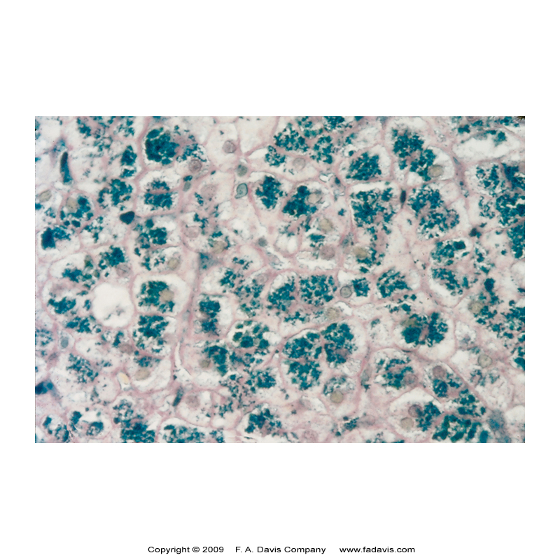 <p>Hemochromatosis Lab Findings &amp; Treatment</p>