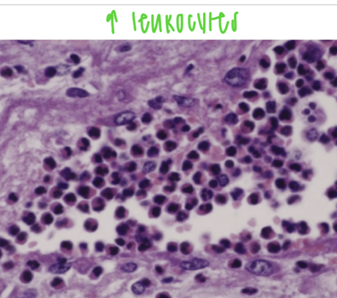 <p>acute active local hyperemia</p>