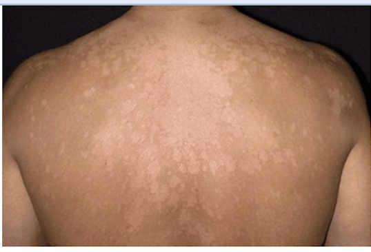 <p>Which fungus is normal flora of the <strong>skin, is</strong> <strong>not contagious </strong>(<strong>benign</strong>) and cause of<strong> non-pruritic</strong> <strong>pityriasis versicolor </strong>(tinea versicolor)?</p>