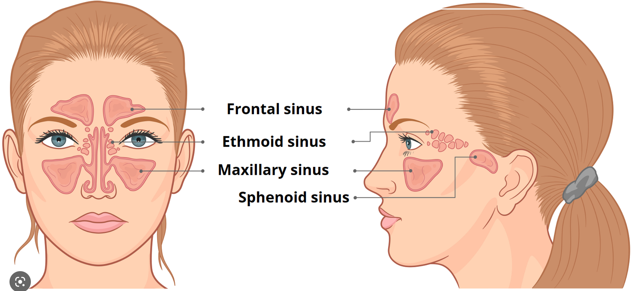 <p>1- frontal sinus 2- ethmoid sinus 3-maxillary sinus 4-sphenoid sinus</p>