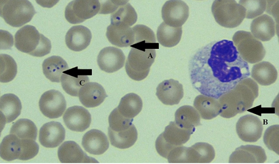 <p>what disease/condition is associated with cells containing various parasitic stages that nearly resemble H-J bodies but with a “ring”?</p>