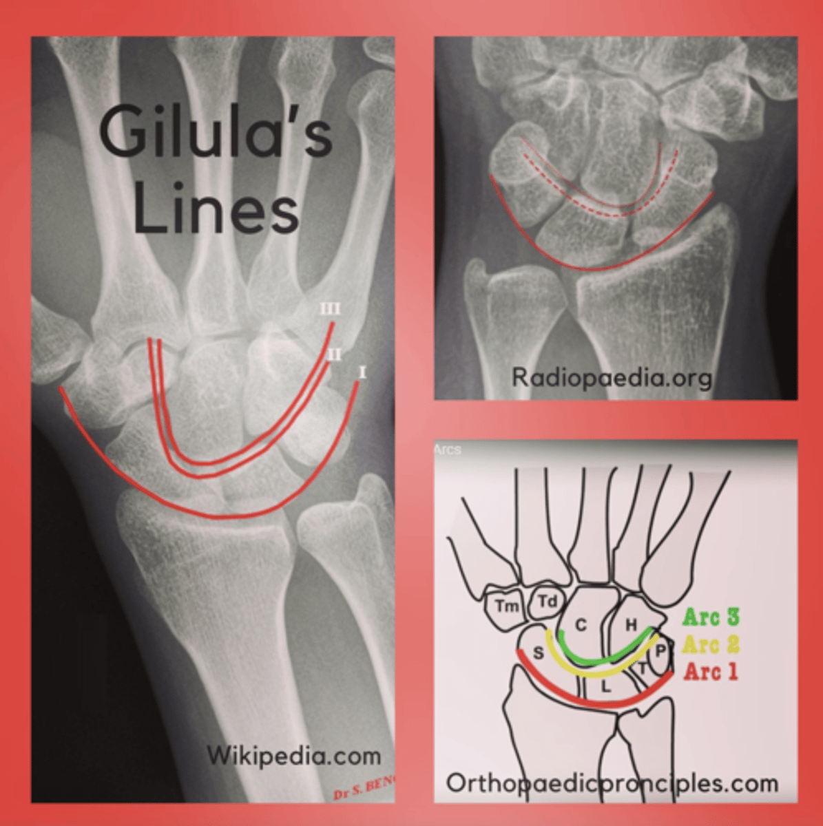 <p>Gilula arcs or lines are three represented curved lines determining carpal alignment in the wrist, essential for identifying normal alignment or suspecting pathology.</p>