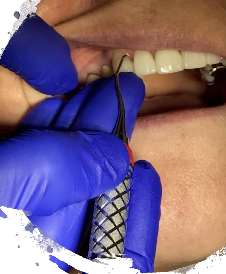 <ul><li><p>ideally establish as close as possible to the working area </p></li><li><p>middle finger rests against ring finger to create a ‘built-up’ fulcrum </p></li></ul><p></p>