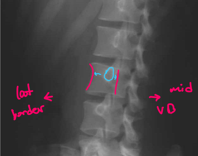 <p>good 45 OBL</p><ul><li><p>MAIN: Z-joints open and in straight line</p></li><li><p>pedicle halfway between mid VB and lateral border of VB</p></li></ul><p></p>