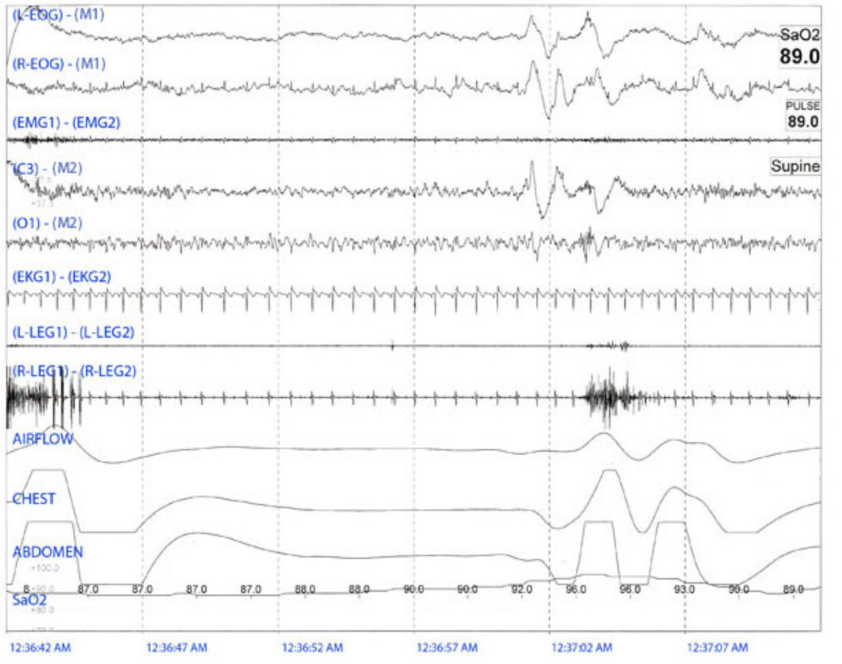 <p>The following 30 second epoch is observed during a sleep study of an adult. Which of the following is shown? S</p>