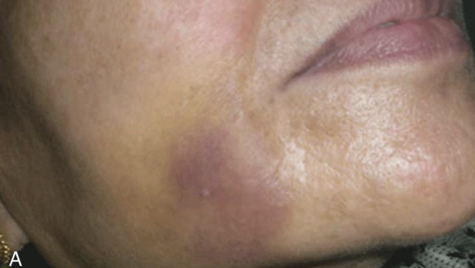 <p>What injection may cause a hematoma? </p>