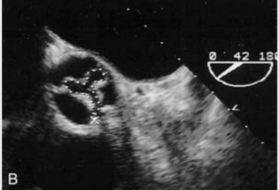 <p>Planimetry is difficult in</p><p>stenosis due to</p><p>calcification around the</p><p>valve with TTE</p><p>Planimetry can used</p><p>during TEE</p>