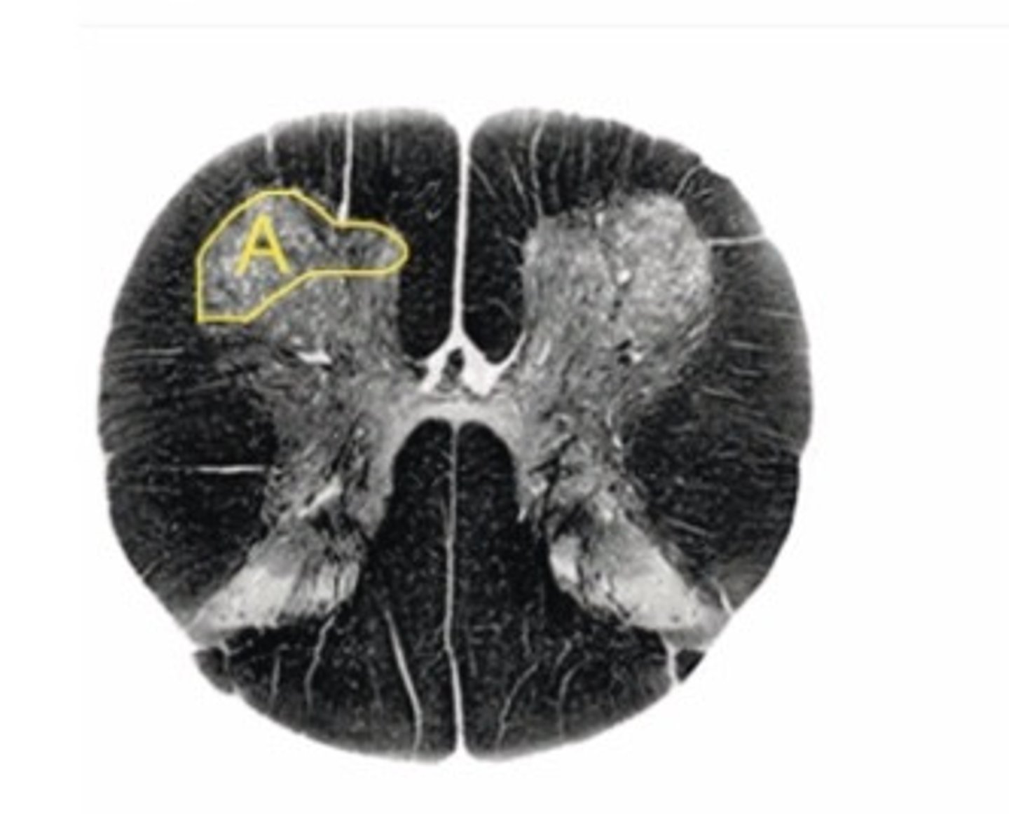 <p>Describe the signs/symptoms that you will see if structure "A" is lesioned.</p>