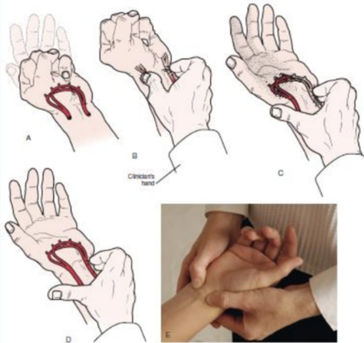 <p>- identify vascular compromise</p><p>- The patient is asked to open and close the hand several times as quickly as possible and then squeeze the hand tightly. The examiner's thumb and index finger are placed over the radial and ulnar arteries, compressing them. The patient then opens the hand while pressure is maintained over the arteries. One artery is tested by releasing the pressure over that artery to see if the hand flushes. The other artery is then tested in a similar fashion.</p>