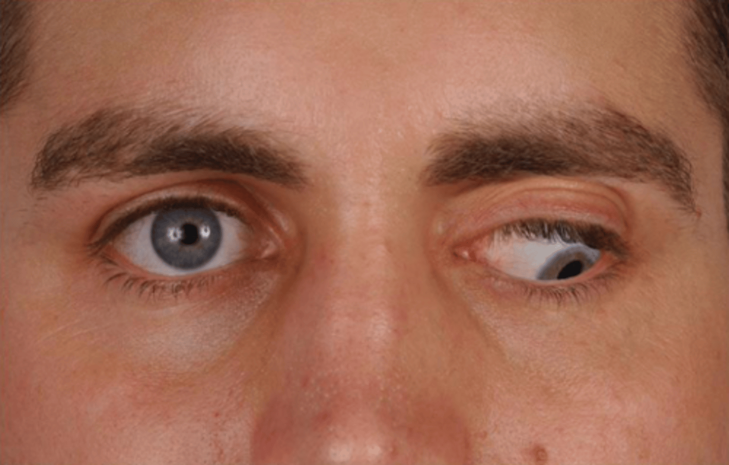 <p><span><u>Etio</u></span>: <strong>sudden dysfunction of muscles associated with CN III;</strong> subarachnoid hemorrhage, midbrain lesions, intracranial aneurysm, ischemia, trauma</p><p><span><u>S&amp;S</u></span>: diplopia, <strong>ptosis </strong>(droopy eyelid), headache “worst of my life” → subarachnoid hemorrhage</p><p><span><u>Testing</u></span>: MRI to r/o lesion, contrast enhanced MRI or CTA to r/o aneurysm, non contrast CT, then LP to r/o meningitis</p><p><span><u>Tx</u></span>: admit to hospital, emergent consult to neurosurgeon</p>