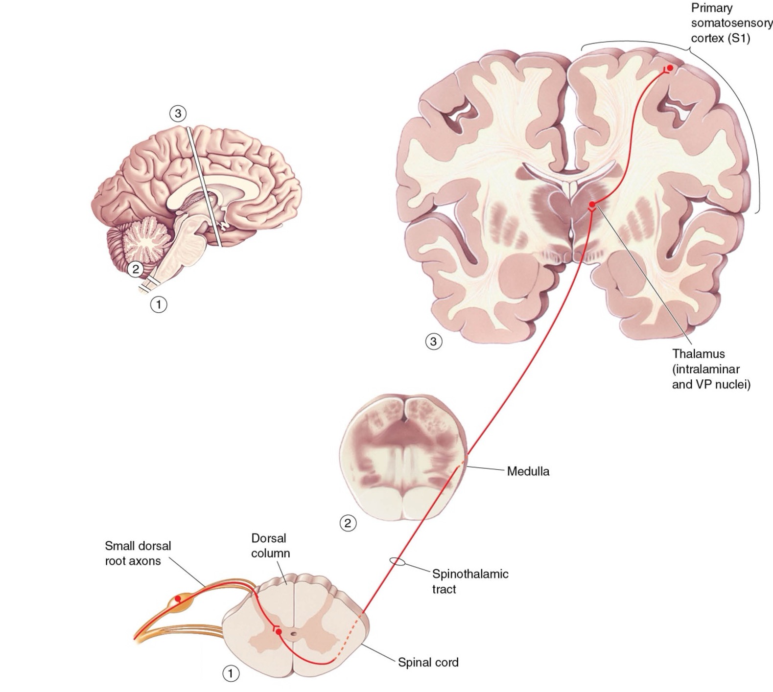 <p><strong>1. Peripheral Nociceptors</strong></p><ul><li><p>Located in <strong>skin, muscles, joints, and viscera</strong>.</p></li><li><p><strong>Receptor type:</strong> Free nerve endings.</p></li><li><p><strong>Fiber types:</strong></p><ul><li><p><strong>Aδ fibers:</strong> thinly myelinated, fast → sharp, localized pain.</p></li><li><p><strong>C fibers:</strong> unmyelinated, slow → dull, burning, diffuse pain.</p></li></ul></li><li><p><strong>Stimulus:</strong> Mechanical, thermal, or chemical injury triggers depolarization.</p></li></ul><div data-type="horizontalRule"><hr></div><p><strong>2. First-Order Neurons</strong></p><ul><li><p><strong>Cell bodies:</strong></p><ul><li><p>Dorsal root ganglia (body).</p></li><li><p>Trigeminal ganglion (face).</p></li></ul></li><li><p><strong>Axon path:</strong></p><ul><li><p>Peripheral axon detects stimulus.</p></li><li><p>Central axon enters <strong>dorsal horn</strong> of spinal cord (or trigeminal nuclei for face).</p></li></ul></li></ul><div data-type="horizontalRule"><hr></div><p><strong>3. Dorsal Horn Synapse</strong></p><ul><li><p><strong>Synapse site:</strong> Lamina I (marginal layer) &amp; Lamina II (substantia gelatinosa).</p></li><li><p><strong>Neurotransmitters:</strong> Glutamate, Substance P (enhances excitability).</p></li><li><p><strong>Modulation:</strong> Local inhibitory interneurons and descending pathways can suppress or enhance signal.</p></li></ul><div data-type="horizontalRule"><hr></div><p><strong>4. Decussation (Crossing Over)</strong></p><ul><li><p>Second-order neurons <strong>cross to the contralateral side</strong> of spinal cord.</p></li><li><p><strong>Pathway:</strong> Anterolateral system / spinothalamic tract.</p></li></ul><div data-type="horizontalRule"><hr></div><p><strong>5. Ascending Tracts</strong></p><ul><li><p><strong>Spinothalamic tract:</strong> Carries discriminative pain and temperature.</p></li><li><p><strong>Other tracts:</strong></p><ul><li><p>Spinoreticular → arousal and alertness.</p></li><li><p>Spinomesencephalic → orienting responses, emotional aspects.</p></li></ul></li></ul><div data-type="horizontalRule"><hr></div><p><strong>6. Thalamic Relay</strong></p><ul><li><p>Second-order neurons terminate in:</p><ul><li><p><strong>Ventral posterolateral (VPL) nucleus</strong> → body.</p></li><li><p><strong>Ventral posteromedial (VPM) nucleus</strong> → face.</p></li></ul></li><li><p>Thalamus integrates signals and relays to cortex.</p></li></ul><div data-type="horizontalRule"><hr></div><p><strong>7. Third-Order Neurons (Cortex)</strong></p><ul><li><p>Project from thalamus to <strong>primary somatosensory cortex (S1)</strong> → conscious perception of pain (location, intensity).</p></li><li><p><strong>Other cortical targets:</strong></p><ul><li><p><strong>Insula</strong> → sensory-emotional integration.</p></li><li><p><strong>Anterior cingulate cortex (ACC)</strong> → motivational/affective aspects of pain.</p></li></ul></li></ul><div data-type="horizontalRule"><hr></div><p><strong>8. Descending Modulation</strong></p><ul><li><p><strong>Pathway:</strong> Periaqueductal gray (PAG) → rostral ventromedial medulla → dorsal horn.</p></li><li><p><strong>Mechanism:</strong> Releases <strong>serotonin, norepinephrine, endogenous opioids</strong> to inhibit nociceptive transmission.</p></li><li><p>Function: Adjusts intensity of pain perception, mediates placebo effects.</p></li></ul><p></p>